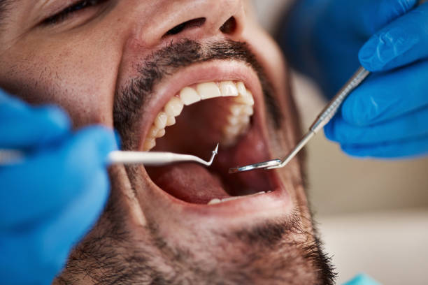 Best Emergency Dentist for Lost Fillings or Crowns in Montverde, FL