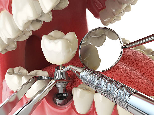 Best Broken or Cracked Tooth Emergency Dentist in Montverde, FL